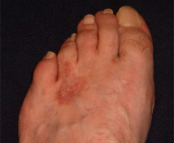 lábfej ekcéma. Eczema foot