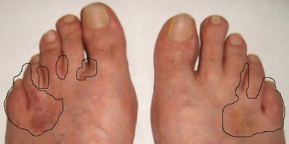 Lábujjak és lábujjak közötti sebek, Sütik használata