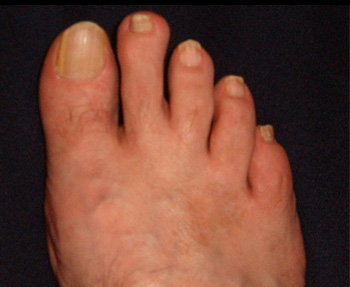 ekc�ma a l�bfejen